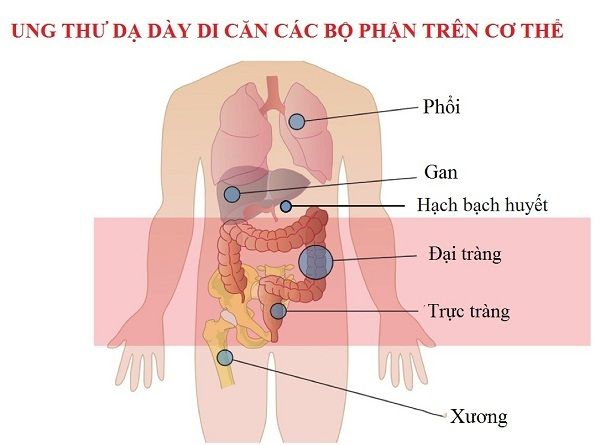 Tìm hiểu căn bệnh ung thư dạ dày di căn sống được bao lâu?